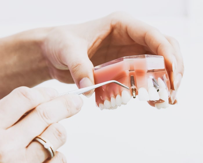 Implants dentaires, Dentiste à Sept-Îles